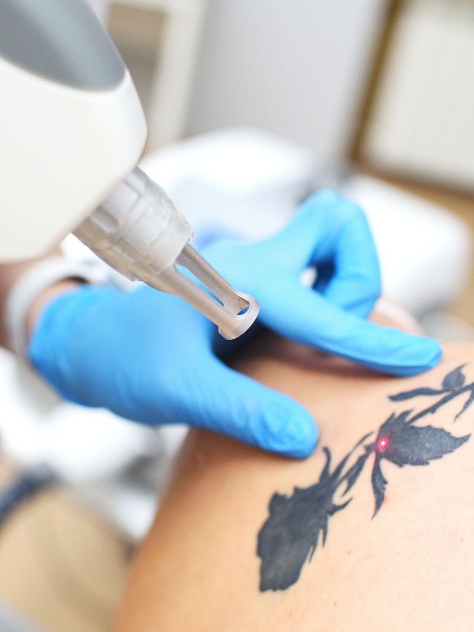 targeting tattoo for removal