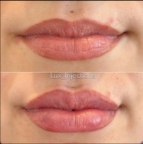 A before and after photo of a woman 's lips.