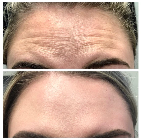 A before and after photo of a woman 's forehead with wrinkles.