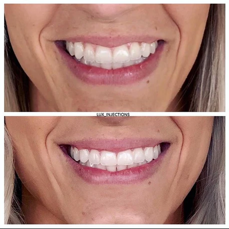 A before and after photo of a woman 's smile.