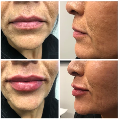 A collage of four photos of a woman 's lips before and after lip injections.
