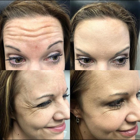 A before and after photo of a woman 's forehead