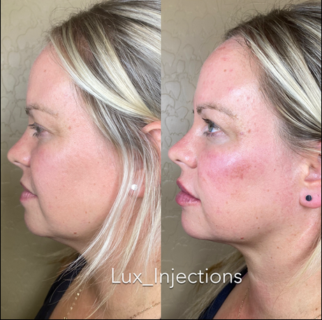 A before and after photo of a woman 's face with lux injections written on the bottom