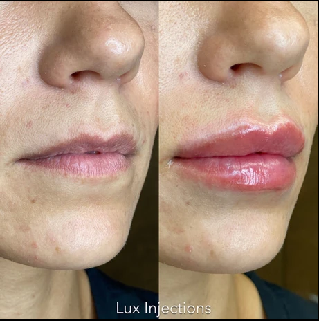 A before and after photo of a woman 's lips.