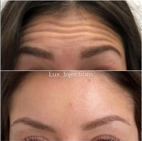 A woman 's forehead before and after botox injections.