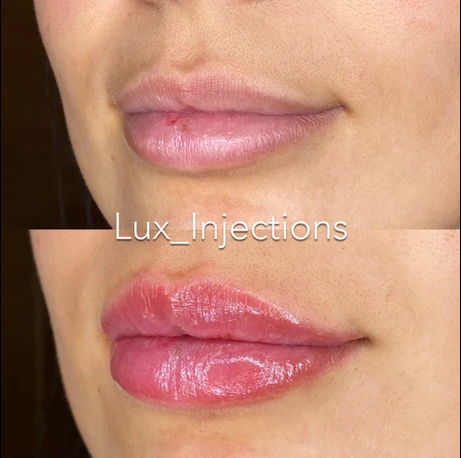 A before and after photo of a woman 's lips with lip injections.