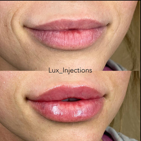 A before and after photo of a woman 's lips with lip injections.