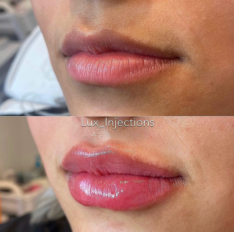 A before and after photo of a woman 's lips.