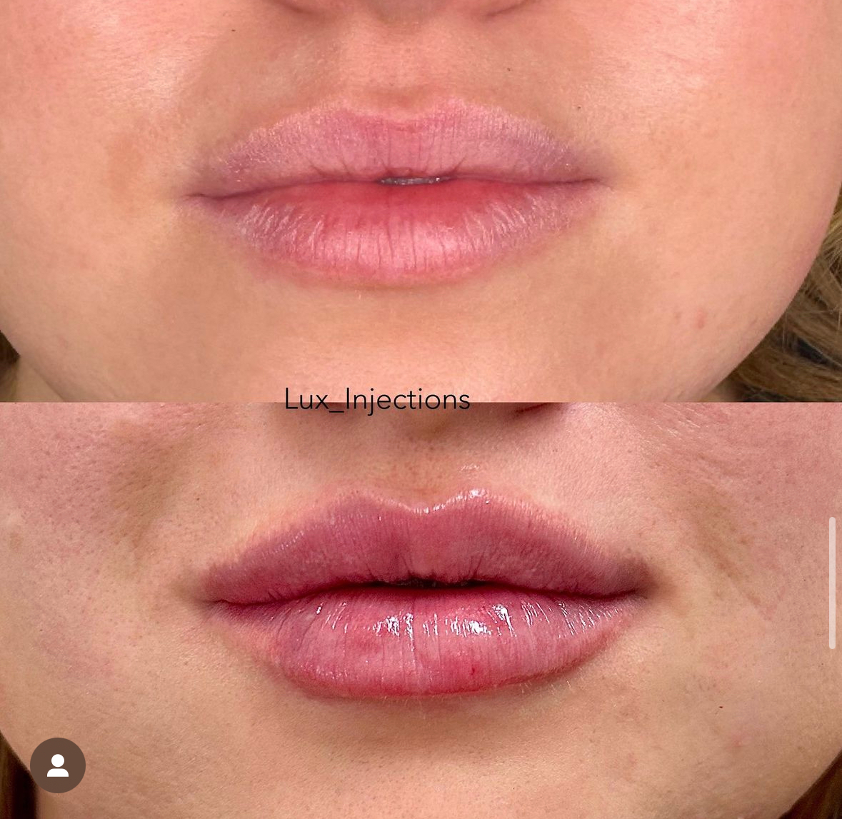 A before and after photo of a woman 's lips.
