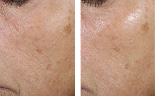 A before and after photo of a woman 's face.
