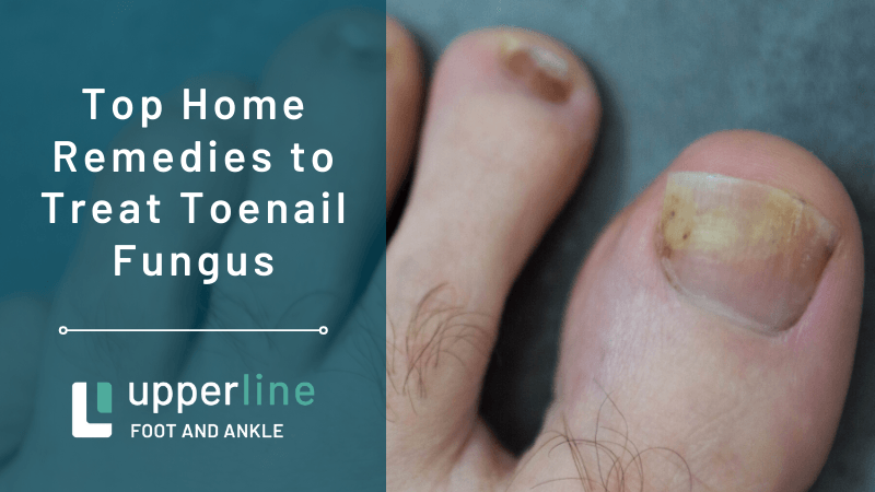 Home Remedies to Treat Toenail Fungus