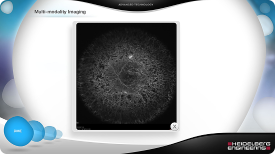 Eye imaging showing a network of blood vessels in the retina, in black and white.