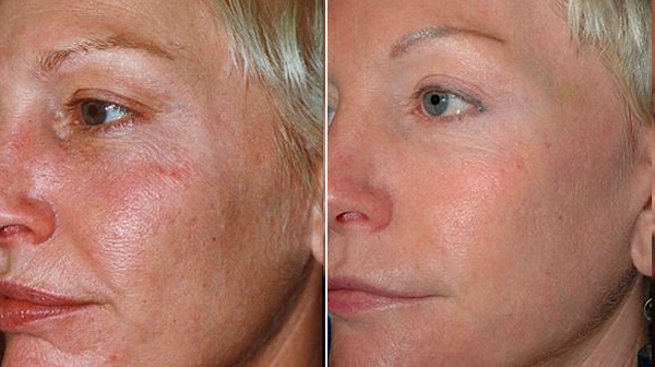Laser Rejuvenation In New York City Before and After Photo