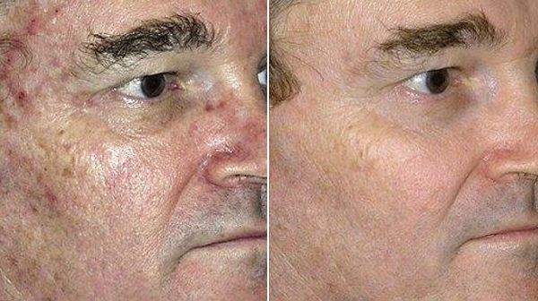 Laser Rejuvenation Before and After Treatment