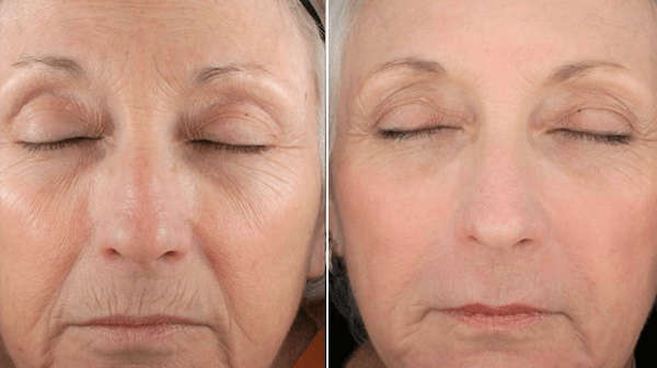 Laser Rejuvenation Wrinkle Reduction In New York City