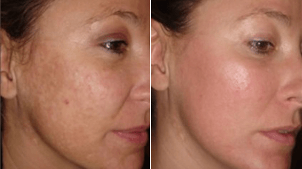Laser Rejuvenation Treatments In New York City Before and After Photos