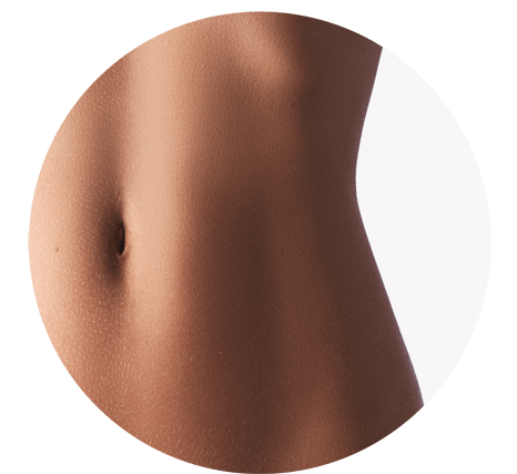 Microneedling Reduces Stretch Marks
