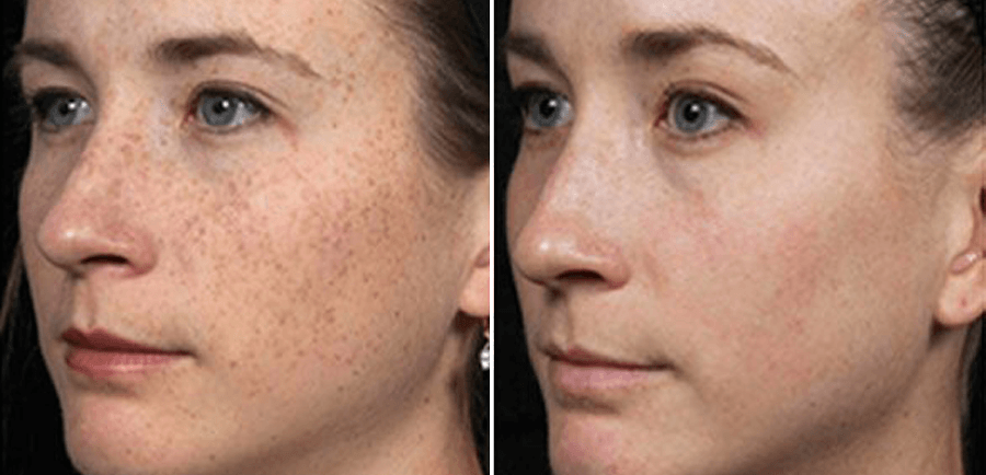 Microneedling before and after pigmentation treatment