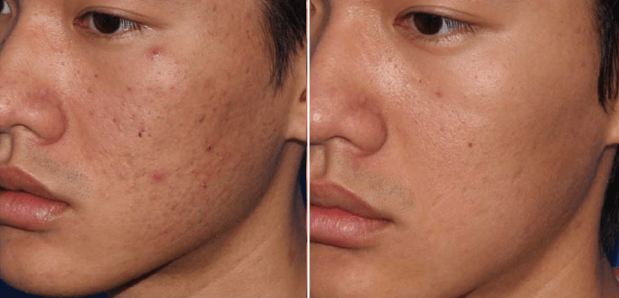 Microneedling before and after acne treatment