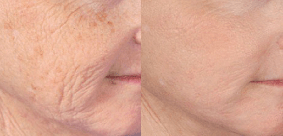 Microneedling before and after anti-aging treatment