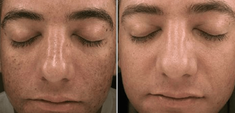 Microneedling before and after acne scar reduction