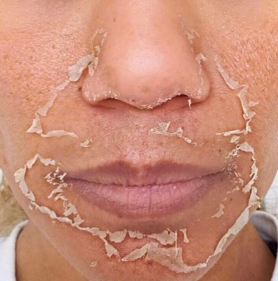 VI Peel and Chemical Peel: The Peeling Process
