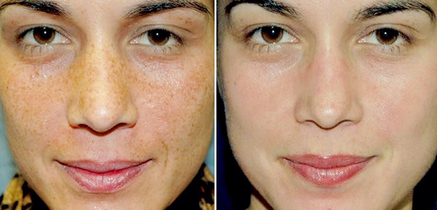 VI Peel Before and After