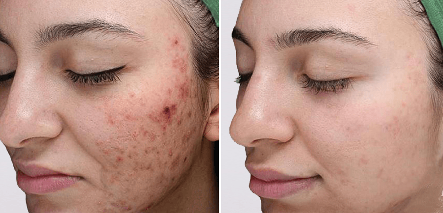 VI Peel Before and After Acne Treatment