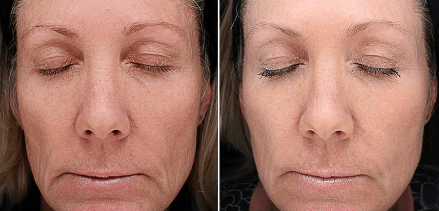 VI Peel Before and After Anti-Aging Treatment