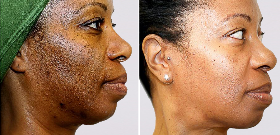 VI Peel Before and After Pigmentation Treatment