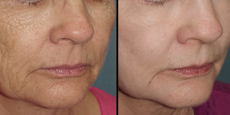Chemical Peel Treatment Before and After Photo # 1