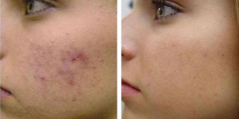 Chemical Peel Treatment: Before and After Photo # 2