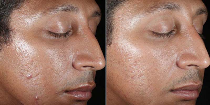 Chemical Peel Treatment: Before and After Photo # 3