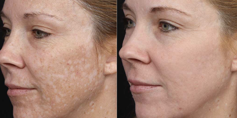 Chemical Peel Treatment: Before and After Photo # 4