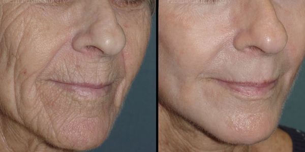 Chemical Peel Treatment: Before and After Photo # 5