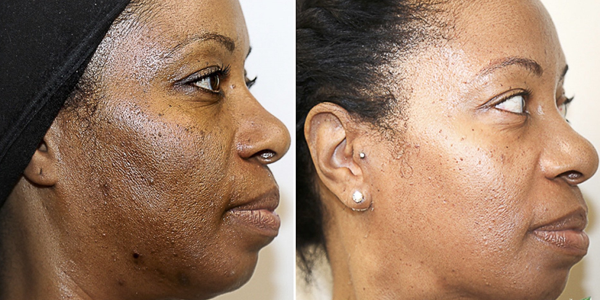 Chemical Peel Treatment: Before and After Photo # 6