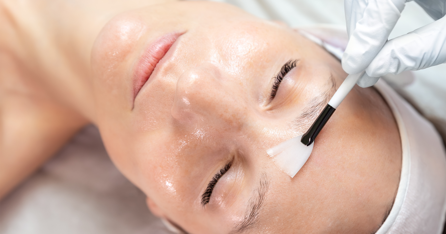 Chemical Peel Treatments in NYC at Spark Laser Center and Medical Spa