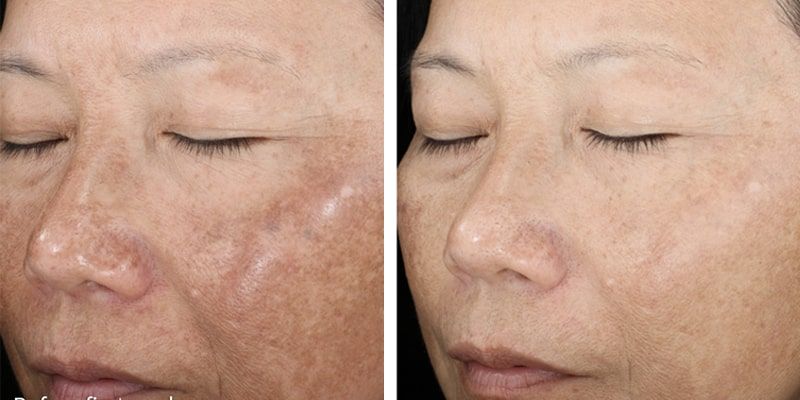 Chemical Peel: Before and After Photo # 10