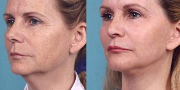 Chemical Peel: Before and After Photo # 11