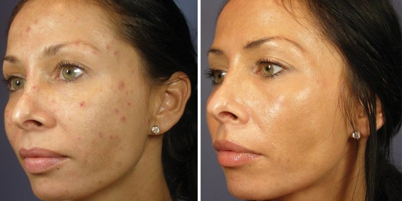 Chemical Peel: Before and After Photo # 7