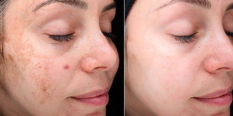 Chemical Peel: Before and After Photo # 8