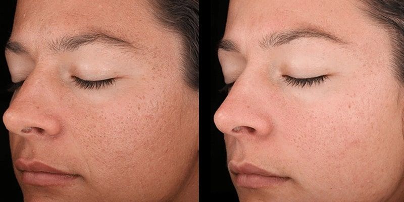 Chemical Peel: Before and After Photo # 9