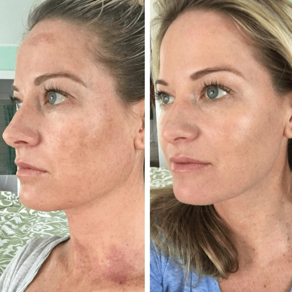 Chemical Peel Treatment NYC before and after photo female 4