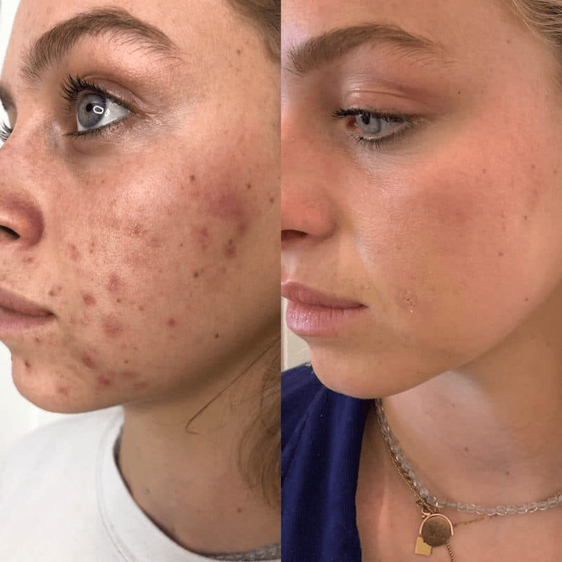 Chemical Peel Treatment NYC before and after photo female 3