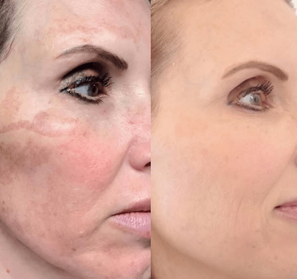 Chemical Peel Treatment NYC before and after photo female 1