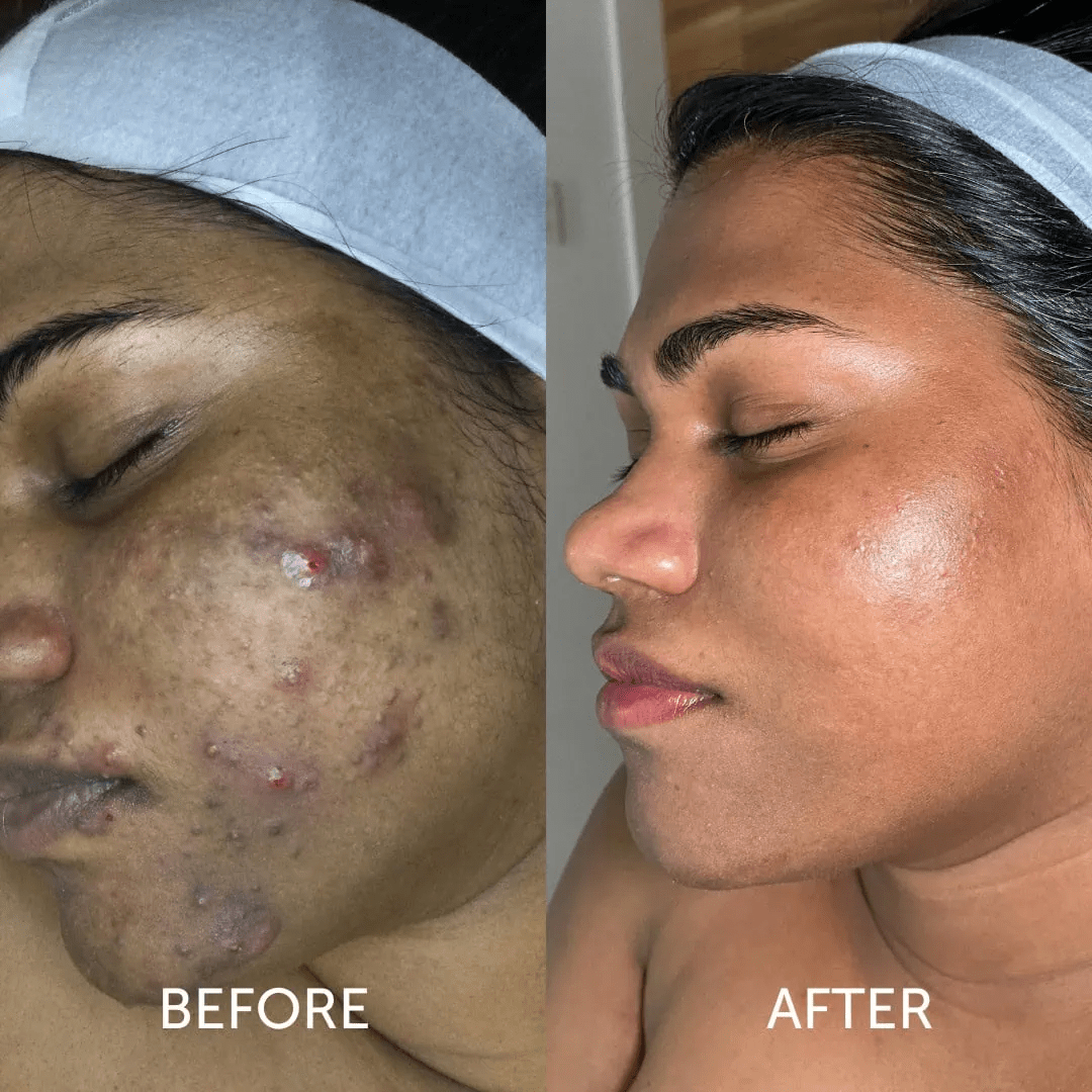 Chemical Peel Treatment NYC before and after photo female 2