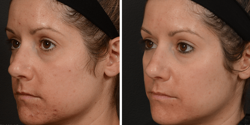 Hydrafacial NYC, before and after treatment photo 1