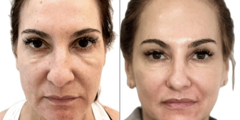 Hydrafacial NYC, before and after treatment photo 2