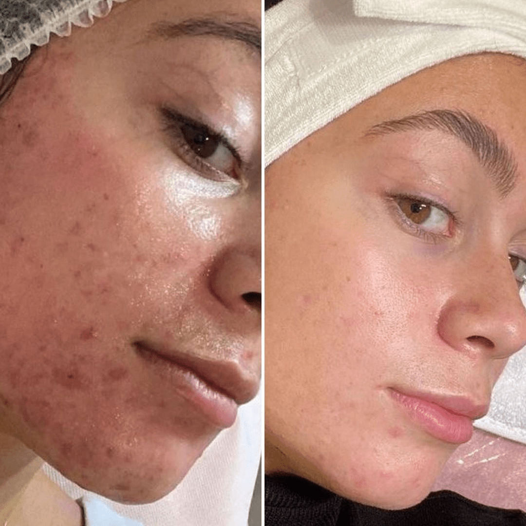 Hydrafacial NYC, before and after treatment photo 4