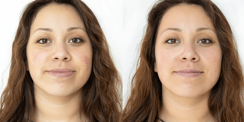 Hydrafacial NYC, before and after treatment photo